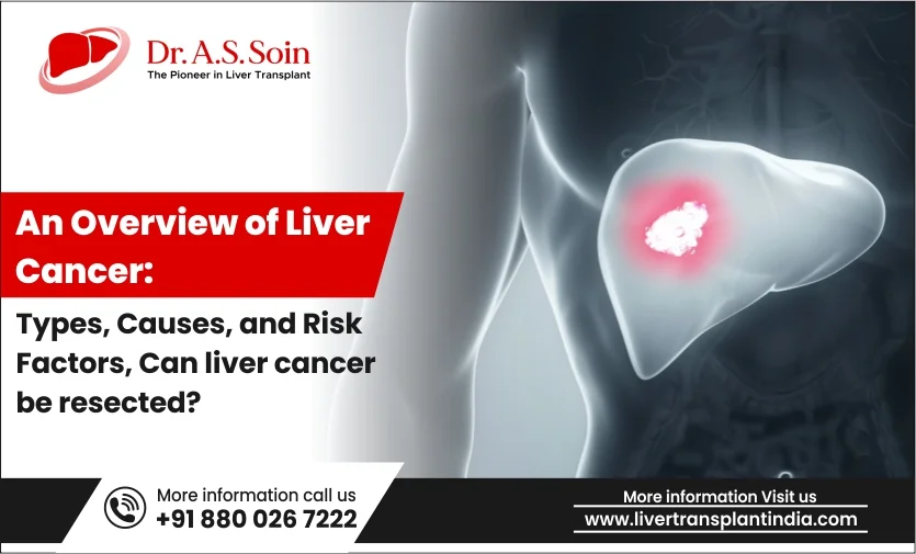 Comprehensive Insights Into Liver Cancer Types Causes And Risks 2633